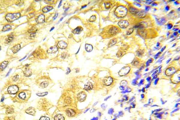 TP53 / p53 Antibody - IHC of P53 (D43) pAb in paraffin-embedded human lung carcinoma tissue.