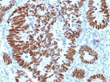 TP53 / p53 Antibody - IHC testing of FFPE human colon carcinoma with p53 antibody. Required HIER: boil tissue sections in 10mM citrate buffer, pH 6, for 10-20 min.