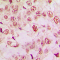 TP53 / p53 Antibody - Immunohistochemical analysis of p53 staining in human lung cancer formalin fixed paraffin embedded tissue section. The section was pre-treated using heat mediated antigen retrieval with sodium citrate buffer (pH 6.0). The section was then incubated with the antibody at room temperature and detected using an HRP conjugated compact polymer system. DAB was used as the chromogen. The section was then counterstained with hematoxylin and mounted with DPX.