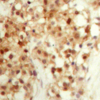 TP53 / p53 Antibody - Immunohistochemical analysis of p53 staining in human ovarian cancer formalin fixed paraffin embedded tissue section. The section was pre-treated using heat mediated antigen retrieval with sodium citrate buffer (pH 6.0). The section was then incubated with the antibody at room temperature and detected using an HRP conjugated compact polymer system. DAB was used as the chromogen. The section was then counterstained with hematoxylin and mounted with DPX.