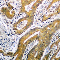 TP53 / p53 Antibody - Immunohistochemical analysis of p53 staining in human colon cancer formalin fixed paraffin embedded tissue section. The section was pre-treated using heat mediated antigen retrieval with sodium citrate buffer (pH 6.0). The section was then incubated with the antibody at room temperature and detected using an HRP polymer system. DAB was used as the chromogen. The section was then counterstained with hematoxylin and mounted with DPX.