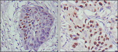 TP53 / p53 Antibody - IHC of paraffin-embedded human esophageal cancer (left) and lung cancer (right), showing nuclear localization using p53 mouse monoclonal antibody with DAB staining.