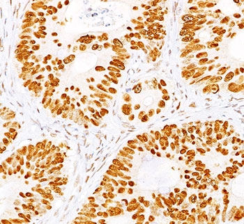 TP53 / p53 Antibody - p53 antibody BP53-12 + DO-7 immunohistochemistry colon.  This image was taken for the unmodified form of this product. Other forms have not been tested.
