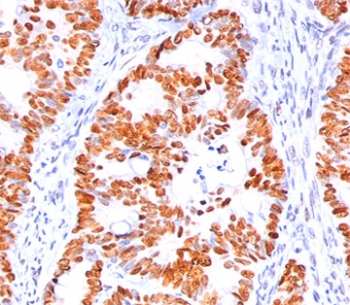 TP53 / p53 Antibody - p53 antibody BP53-12 immunohistochemistry colon carcinoma.  This image was taken for the unmodified form of this product. Other forms have not been tested.