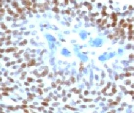 TP53 / p53 Antibody - IHC staining of human colon carcinoma with p53 antibody (CTA53-1).  This image was taken for the unmodified form of this product. Other forms have not been tested.