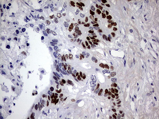 TP53 / p53 Antibody - Immunohistochemical staining of paraffin-embedded Adenocarcinoma of Human colon tissue using anti-TP53 mouse monoclonal antibody. (Heat-induced epitope retrieval by 1 mM EDTA in 10mM Tris, pH8.5, 120C for 3min,