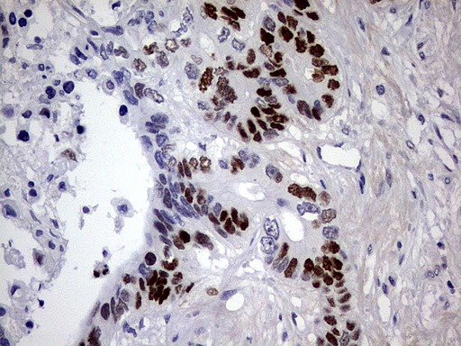 TP53 / p53 Antibody - IHC of paraffin-embedded Adenocarcinoma of Human colon tissue using anti-TP53 mouse monoclonal antibody. (Heat-induced epitope retrieval by 1 mM EDTA in 10mM Tris, pH8.5, 120°C for 3min).