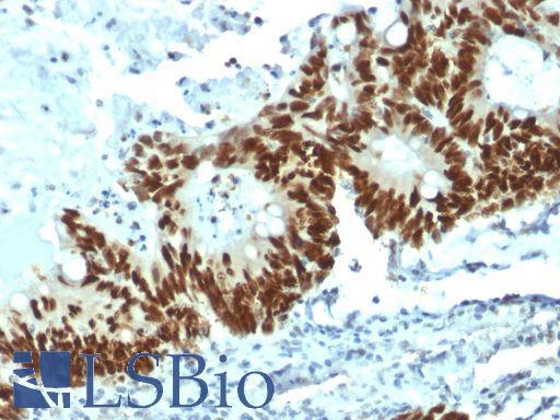 TP53 / p53 Antibody - Strong nuclear IHC staining of p53 in a formalin-fixed, paraffin-embedded human colon carcinoma.