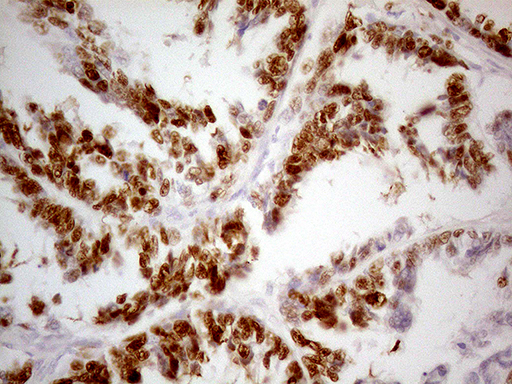 TP53 / p53 Antibody - Immunohistochemical staining of paraffin-embedded Adenocarcinoma of Human ovary tissue using anti-TP53 mouse monoclonal antibody. (Heat-induced epitope retrieval by 1mM EDTA in 10mM Tris buffer. (pH8.0) at 120°C for 3 min. (1:500)