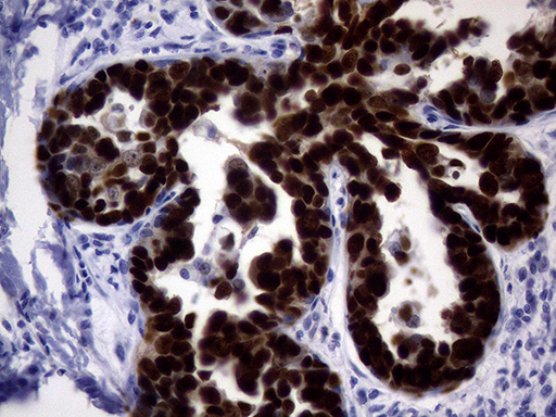 TP53 / p53 Antibody - Immunohistochemical staining of paraffin-embedded Adenocarcinoma of Human breast tissue tissue using anti-TP53 mouse monoclonal antibody. (Heat-induced epitope retrieval by 1mM EDTA in 10mM Tris buffer. (pH8.0) at 120°C for 3 min. (1:2400)