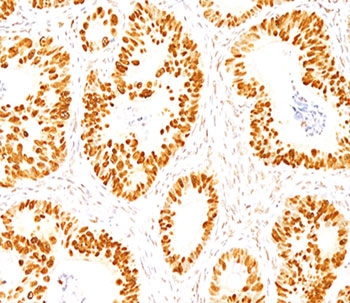 TP53 / p53 Antibody - p53 antibody DO-7 immunohistochemistry colon.  This image was taken for the unmodified form of this product. Other forms have not been tested.