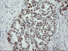 TP53 / p53 Antibody - IHC of paraffin-embedded Adenocarcinoma of Human ovary tissue using anti-TP53 mouse monoclonal antibody. (Heat-induced epitope retrieval by 10mM citric buffer, pH6.0, 100C for 10min).