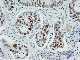 TP53 / p53 Antibody - IHC of paraffin-embedded Carcinoma of Human pancreas tissue using anti-TP53 mouse monoclonal antibody. (Heat-induced epitope retrieval by 10mM citric buffer, pH6.0, 100C for 10min).