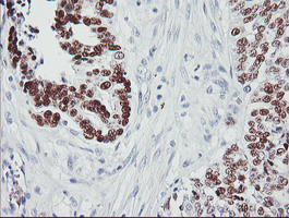 TP53 / p53 Antibody - IHC of paraffin-embedded Adenocarcinoma of Human ovary tissue using anti-TP53 mouse monoclonal antibody.