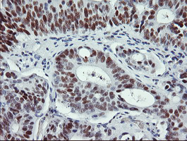 TP53 / p53 Antibody - IHC of paraffin-embedded Carcinoma of Human pancreas tissue using anti-TP53 mouse monoclonal antibody.