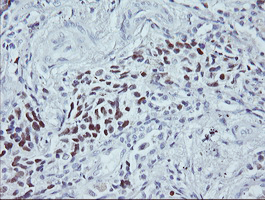 TP53 / p53 Antibody - IHC of paraffin-embedded Carcinoma of Human lung tissue using anti-TP53 mouse monoclonal antibody. (Heat-induced epitope retrieval by 10mM citric buffer, pH6.0, 100C for 10min).