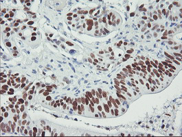 TP53 / p53 Antibody - IHC of paraffin-embedded Carcinoma of Human pancreas tissue using anti-TP53 mouse monoclonal antibody.