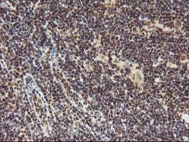 TP53 / p53 Antibody - IHC of paraffin-embedded Human lymphoma tissue using anti-TP53 mouse monoclonal antibody. (Heat-induced epitope retrieval by 10mM citric buffer, pH6.0, 100C for 10min).