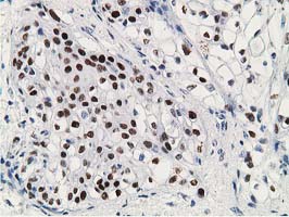 TP53 / p53 Antibody - IHC of paraffin-embedded Carcinoma of Human pancreas tissue using anti-TP53 mouse monoclonal antibody. (Heat-induced epitope retrieval by 10mM citric buffer, pH6.0, 100C for 10min).