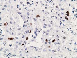 TP53 / p53 Antibody - IHC of paraffin-embedded Carcinoma of Human bladder tissue using anti-TP53 mouse monoclonal antibody. (Heat-induced epitope retrieval by 10mM citric buffer, pH6.0, 100C for 10min).