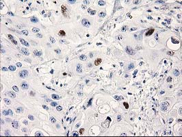 TP53 / p53 Antibody - IHC of paraffin-embedded Carcinoma of Human bladder tissue using anti-TP53 mouse monoclonal antibody.