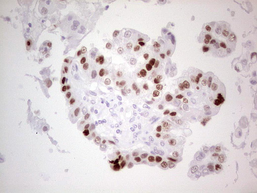 TP53 / p53 Antibody - Immunohistochemical staining of paraffin-embedded Adenocarcinoma of Human ovary tissue using anti-TP53 mouse monoclonal antibody. (Heat-induced epitope retrieval by 1 mM EDTA in 10mM Tris, pH8.5, 120C for 3min,