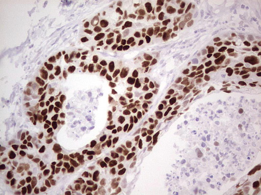 TP53 / p53 Antibody - Immunohistochemical staining of paraffin-embedded Carcinoma of Human kidney tissue using anti-TP53 mouse monoclonal antibody. (Heat-induced epitope retrieval by 1 mM EDTA in 10mM Tris, pH8.5, 120C for 3min,