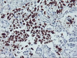 TP53 / p53 Antibody - IHC of paraffin-embedded Carcinoma of Human lung tissue using anti-TP53 mouse monoclonal antibody.