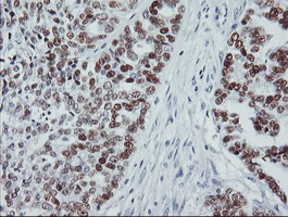 TP53 / p53 Antibody - IHC of paraffin-embedded Adenocarcinoma of Human ovary tissue using anti-TP53 mouse monoclonal antibody.