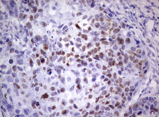 TP53 / p53 Antibody - Immunohistochemical staining of paraffin-embedded Carcinoma of Human kidney tissue using anti-TP53 Mouse monoclonal antibody.  heat-induced epitope retrieval by 1 mM EDTA in 10mM Tris, pH8.5, 120C for 3min)