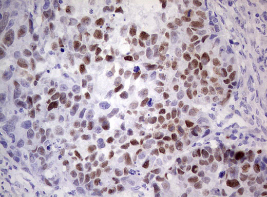 TP53 / p53 Antibody - Immunohistochemical staining of paraffin-embedded Carcinoma of Human kidney tissue using anti-TP53 Mouse monoclonal antibody.  heat-induced epitope retrieval by 1 mM EDTA in 10mM Tris, pH8.5, 120C for 3min)