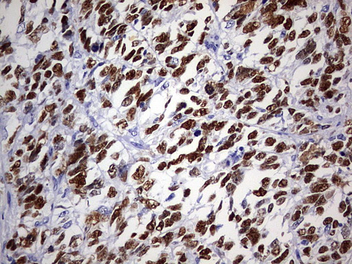 TP53 / p53 Antibody - IHC of paraffin-embedded Adenocarcinoma of Human endometrium tissue using anti-TP53 mouse monoclonal antibody. (Heat-induced epitope retrieval by 1 mM EDTA in 10mM Tris, pH9.0, 120°C for 3min).