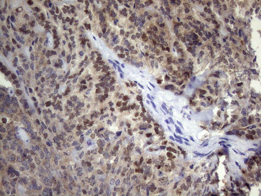 TP53 / p53 Antibody - Immunohistochemical staining of paraffin-embedded Adenocarcinoma of Human ovary tissue using anti-p53 mouse monoclonal antibody. (Heat-induced epitope retrieval by 1mM EDTA in 10mM Tris buffer. (pH8.5) at 120°C for 3 min. (1:500)
