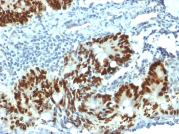 TP53 / p53 Antibody - IHC testing of FFPE human colon carcinoma with p53 antibody (clone Pab 1801). Required HIER: boil tissue sections in 10mM Citrate buffer, pH 6.0, for 10-20 min followed by cooling at RT for 20 min.