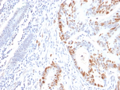 TP53 / p53 Antibody - Formalin-paraffin human Colon Carcinoma stained with p53 Mouse Recombinant Monoclonal Antibody (rBP53-12).