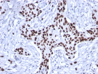 TP53 / p53 Antibody - Formalin-fixed, paraffin-embedded human Breast Carcinoma stained with p53 Mouse Recombinant Monoclonal Antibody (rTP53/1739)