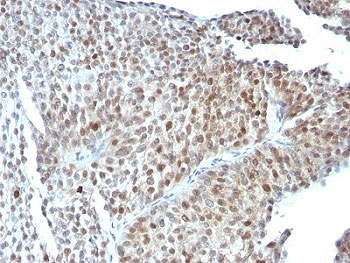 TP53 / p53 Antibody - Formalin-fixed, paraffin-embedded human bladder carcinoma stained with anti-p53 antibody (SPM589).  This image was taken for the unmodified form of this product. Other forms have not been tested.