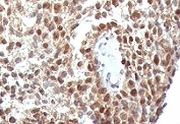 TP53 / p53 Antibody - Formalin-fixed, paraffin-embedded human colon carcinoma stained with anti-p53 antibody (SPM590).  This image was taken for the unmodified form of this product. Other forms have not been tested.