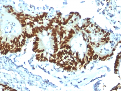 TP53 / p53 Antibody - Formalin-fixed, paraffin-embedded human Colon Carcinoma stained with p53 Recombinant Rabbit Monoclonal Antibody (TP53/1799R).