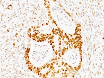 TP53 / p53 Antibody - Formalin-fixed, paraffin-embedded human colon carcinoma stained with p53 antibody (TRP/817).  This image was taken for the unmodified form of this product. Other forms have not been tested.