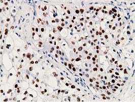 TP53 / p53 Antibody - Immunohistochemical staining of paraffin-embedded Carcinoma of Human pancreas tissue using anti-TP53 mouse monoclonal antibody. (Clone UMAB18, dilution 1:100; heat-induced epitope retrieval by 10mM citric buffer, pH6.0, 120C for 3min)