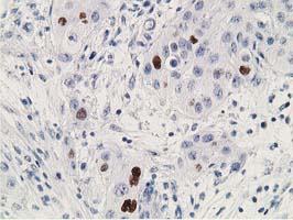 TP53 / p53 Antibody - Immunohistochemical staining of paraffin-embedded Carcinoma of Human bladder tissue using anti-TP53 mouse monoclonal antibody. (Clone UMAB18, dilution 1:100; heat-induced epitope retrieval by 10mM citric buffer, pH6.0, 120C for 3min)
