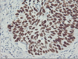 TP53 / p53 Antibody - Immunohistochemical staining of paraffin-embedded Carcinoma of Human lung tissue using anti-TP53 mouse monoclonal antibody. (Clone UMAB19, dilution 1:100; heat-induced epitope retrieval by 10mM citric buffer, pH6.0, 120C for 3min)