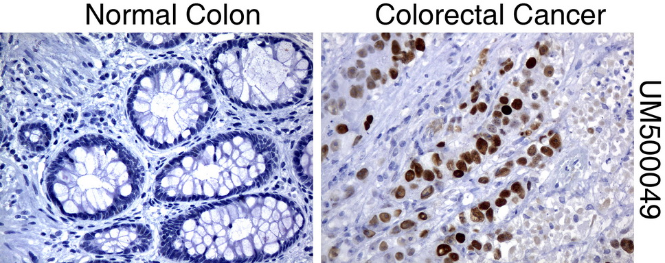 TP53 / p53 Antibody - Immunohistochemical staining of paraffin-embedded Human normal colon tissue and colonrectal cancer tissue using anti-TP53 mouse monoclonal antibody.  heat-induced epitope retrieval by 10mM citric buffer, pH6.0, 120C for 3min)