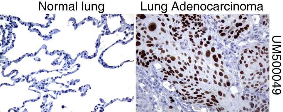 TP53 / p53 Antibody - Immunohistochemical staining of paraffin-embedded Human normal lung tissue and lung adenocarcinoma tissue using anti-TP53 mouse monoclonal antibody.  heat-induced epitope retrieval by 10mM citric buffer, pH6.0, 120C for 3min)