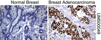 TP53 / p53 Antibody - Immunohistochemical staining of paraffin-embedded Human normal breast tissue and breast adenocarcinoma tissue using anti-TP53 mouse monoclonal antibody.  heat-induced epitope retrieval by 10mM citric buffer, pH6.0, 120C for 3min)