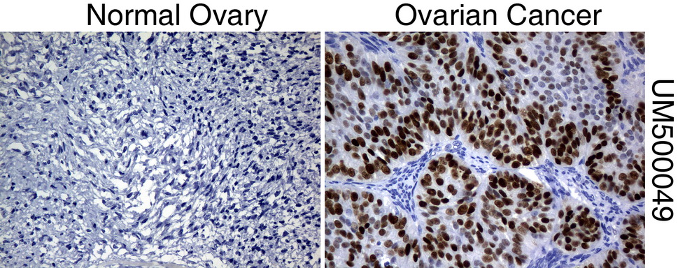 TP53 / p53 Antibody - Immunohistochemical staining of paraffin-embedded Human normal ovary tissue and ovary cancer tissue using anti-TP53 mouse monoclonal antibody.  heat-induced epitope retrieval by 10mM citric buffer, pH6.0, 120C for 3min)