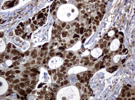 TP53 / p53 Antibody - Immunohistochemical staining of paraffin-embedded Adenocarcinoma of Human breast tissue using anti-TP53 mouse monoclonal antibody.  heat-induced epitope retrieval by 10mM citric buffer, pH6.0, 120C for 3min)