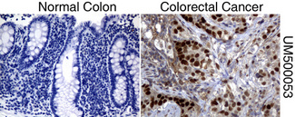 TP53 / p53 Antibody - Immunohistochemical staining of paraffin-embedded Human normal colon tissue and colorectal cancer tissue using anti-TP53 mouse monoclonal antibody.  heat-induced epitope retrieval by 10mM citric buffer, pH6.0, 120C for 3min)
