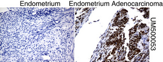 TP53 / p53 Antibody - Immunohistochemical staining of paraffin-embedded Human normal endometrium tissue and endometrium adenocarcinoma tissue using anti-TP53 mouse monoclonal antibody.  heat-induced epitope retrieval by 10mM citric buffer, pH6.0, 120C for 3min)